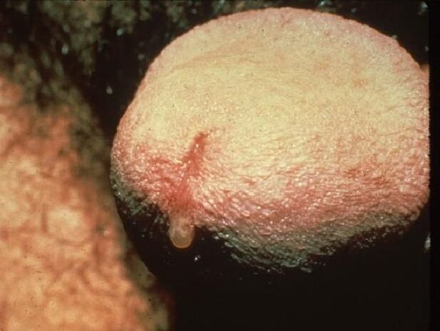 Coceira na uretra por secreción